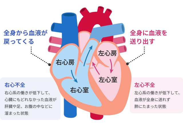 右心不全と左心不全を説明する図です