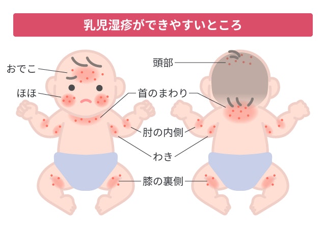 乳児湿疹の症状について説明する図です
