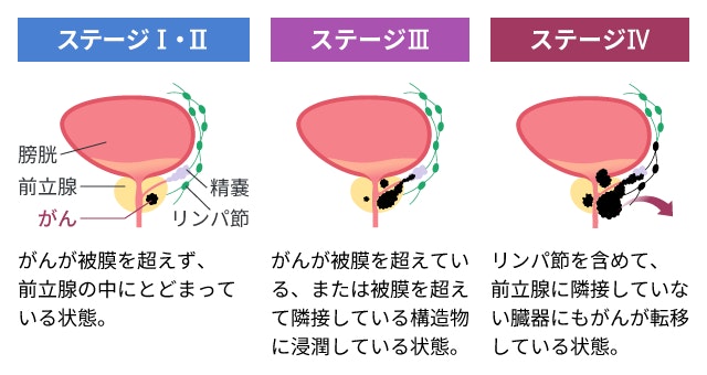 前立腺がんの進行度合いを示すステージ別の模式図。がんが前立腺内にとどまるステージI・IIから、周囲の組織へ浸潤するステージIII、リンパ節や他臓器へ転移するステージIVまでを比較しています。