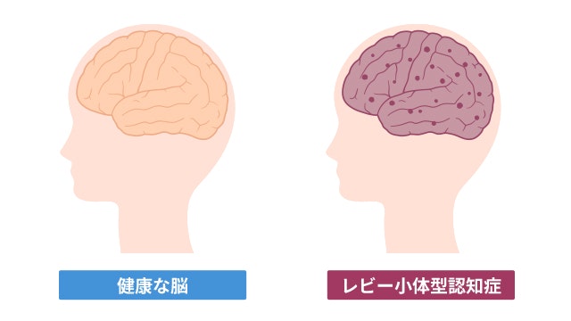 健康な脳とレビー小体型認知症の脳を比較する図です
