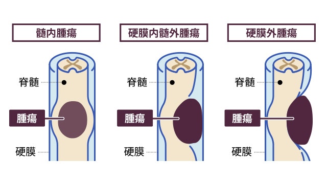 脊髄腫瘍とはどんな病気かを説明する図です