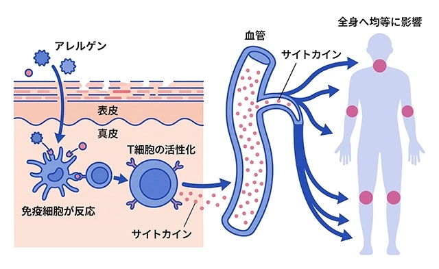 アトピー性皮膚炎の湿疹のメカニズムとして、アレルゲンの侵入からT細胞が活性化し、放出されたサイトカインが血管を通じて全身の皮膚に影響を及ぼすまでの過程を示した模式図。