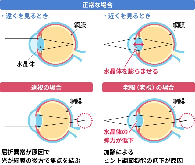 老眼と遠視を説明する図です