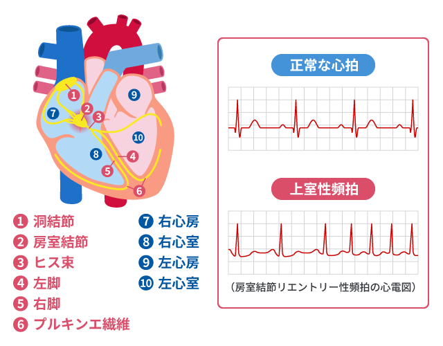 上室性頻拍の心電図診断を説明する図です