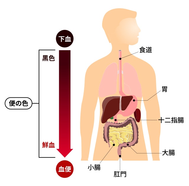 大腸癌の便の色のイラスト