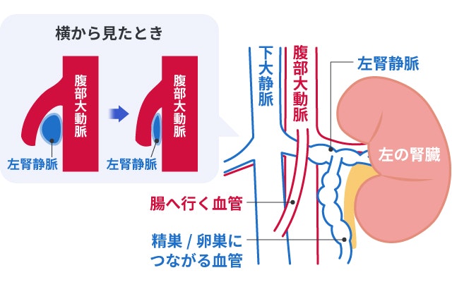 ナットクラッカー症候群を説明する図です