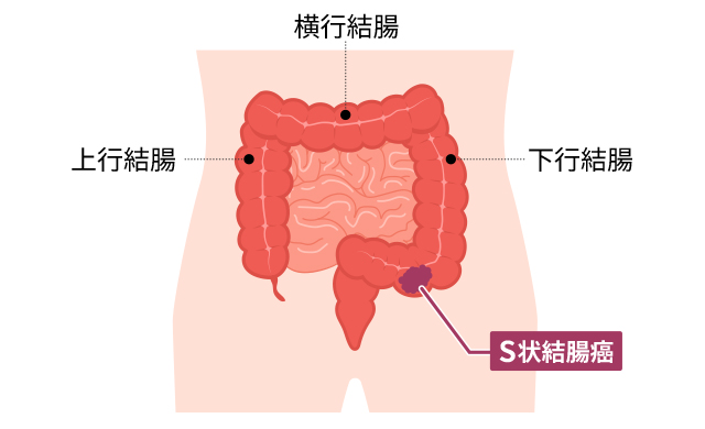 S状結腸癌」とはどのような病気ですか？ ｜S状結腸癌