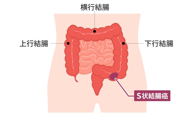S状結腸の場所を説明した図です。