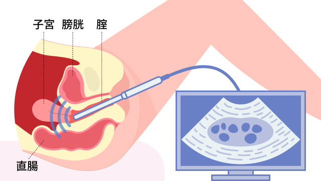 経腟エコーを説明する図です