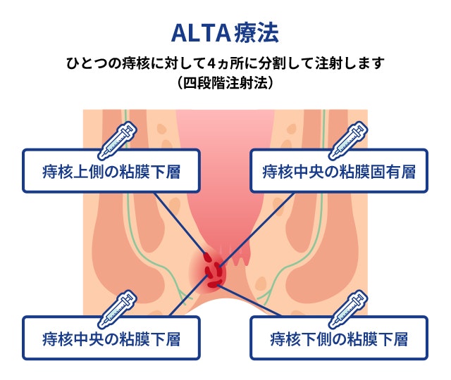 ALTA療法のイラスト