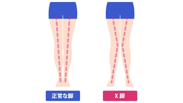 X脚の症状について説明する図です