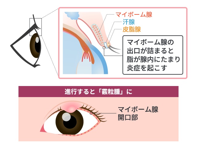マイボーム腺梗塞において、まぶたの縁にあるマイボーム腺の出口を説明する断面図と、マイボーム線が詰まりまぶたに腫れやしこりが生じる霰粒腫へと変化する様子を示す目のイラスト。