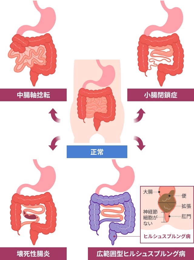 短腸症候群を説明する図です