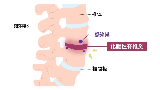 化膿性脊椎炎が生じる部位を説明する図です