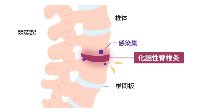 結核性脊椎炎はどのように治療されますか?