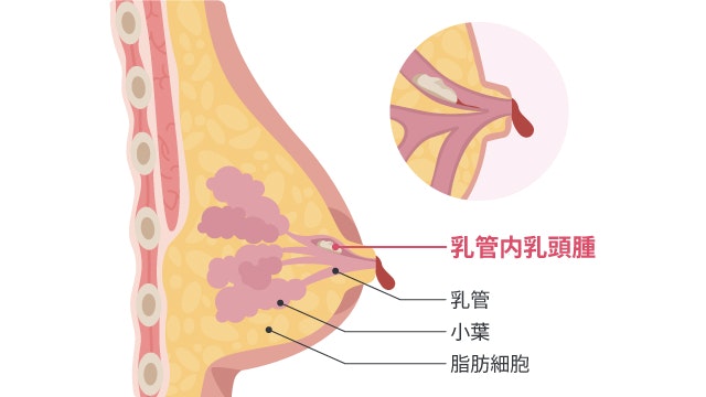 乳管内乳頭腫を説明する図です