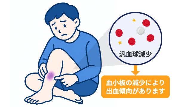 再生不良性貧血における血小板減少と出血症状のメカニズム図解。汎血球減少により血を止める血小板が不足し、出血傾向にある状態。男性が足に生じた「あざ（内出血）」を見て異変に気づいているイラスト。