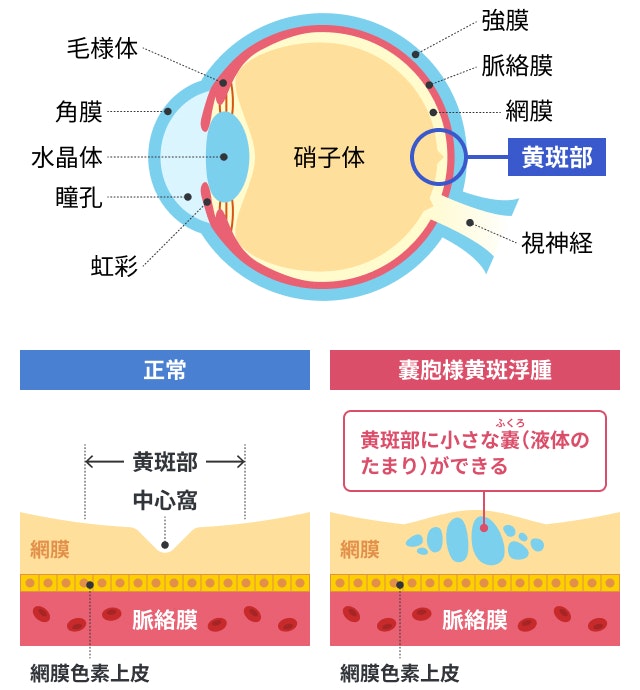 嚢胞様黄斑浮腫を説明する図です