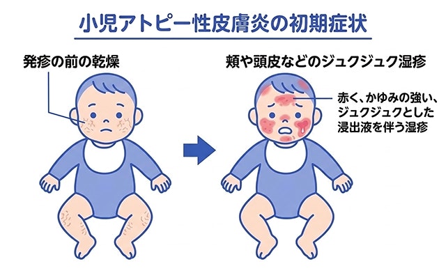 小児アトピー性皮膚炎の初期症状のイラスト。発疹前の皮膚の乾燥から、赤くかゆみが強いジュクジュクとした湿疹が現れる様子を描写しています。