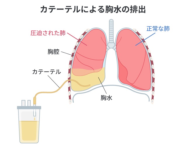 癌性胸水の治療を説明する図です