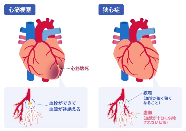 心筋梗塞と狭心症を説明する図です