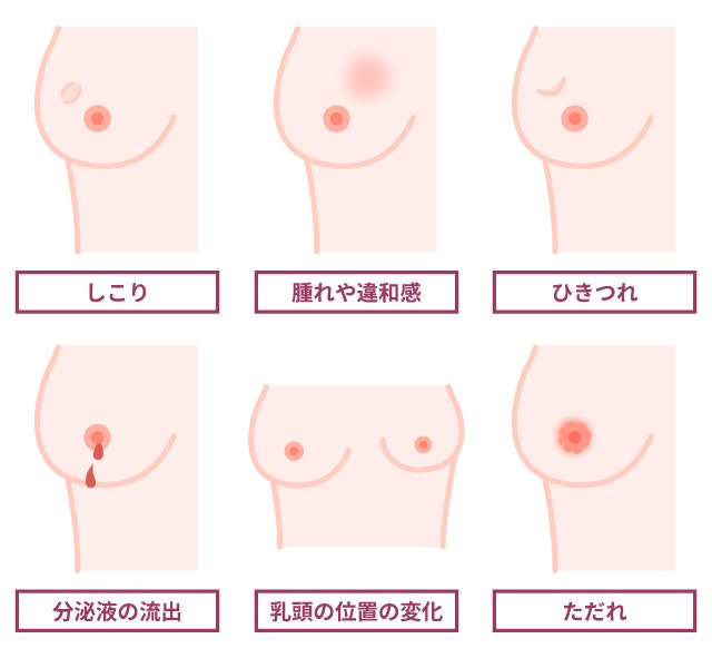 乳がんの代表的な症状を説明する図です