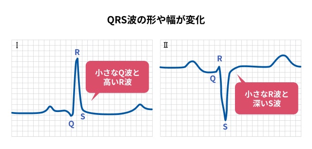 左脚前枝ブロックでの心電図について説明する図です
