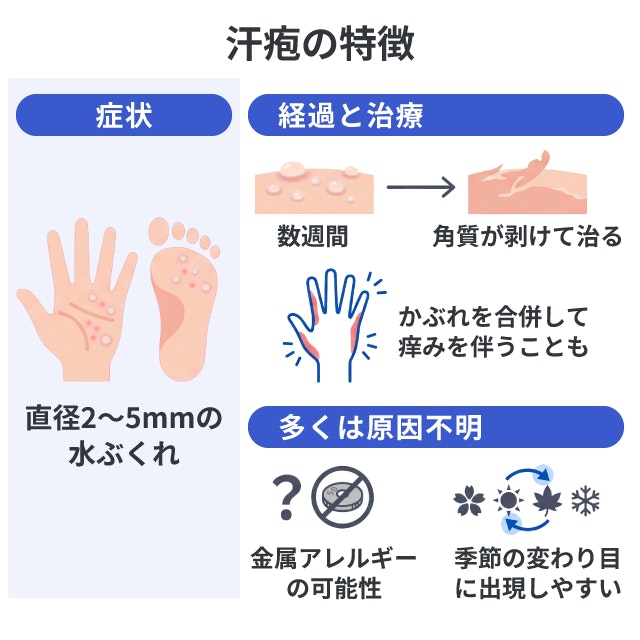 汗疱という病気の特徴を、症状、経過、原因の3つの視点で解説したイラストです。左側の症状の項目では、手のひらと足の裏の図に赤い斑点を描き、直径2〜5ミリメートルの水ぶくれができる様子を示しています。右側の経過の項目では、皮膚に盛り上がった水ぶくれが数週間経つと表面の角質が剥がれて治る過程や、かぶれを合併し指の側面や手の甲に広がり、痒みを伴うケースを描写しています。右下の原因の項目では、多くは原因不明としつつも、硬貨の斜線マークで金属アレルギーの可能性を示唆し、春夏秋冬を表す桜・太陽・紅葉・雪の結晶のマークを用いて、季節の変わり目に症状が出現しやすいという傾向を説明しています。