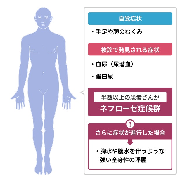 膜性増殖性糸球体腎炎の症状のイラスト