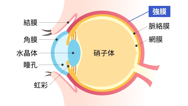 強膜炎を説明する図です