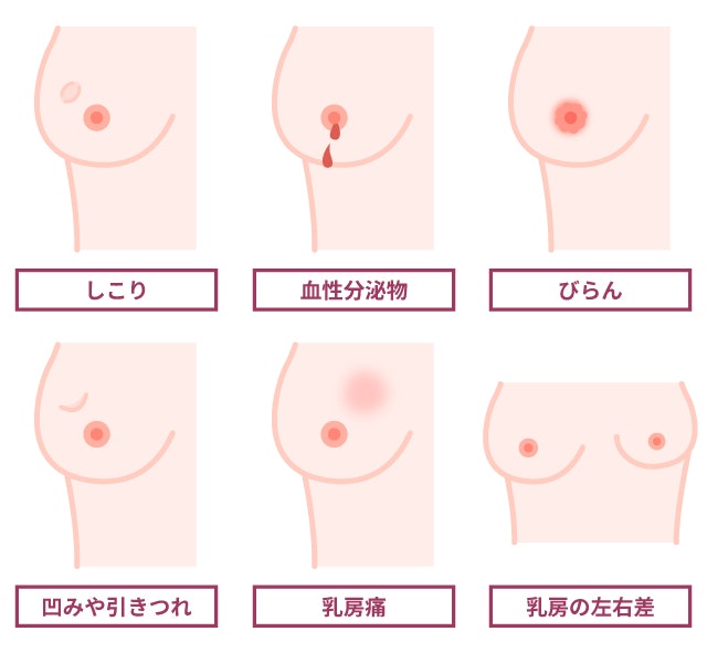 乳がんにおける一般的な見た目の変化を説明する図です
