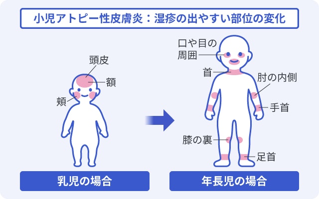 小児アトピー性皮膚炎の湿疹が出やすい部位の変化を示したイラスト。乳児期の頭皮や頬などの顔中心から、年長児の首や肘の内側、膝の裏といった関節部などへ症状が移行していく様子を比較して描いています。