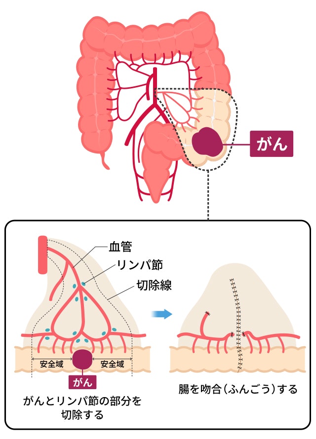 S状結腸切除術を説明した図です。