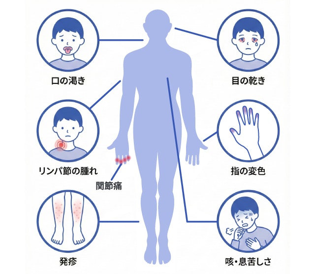 シェーグレン症候群において全身に現れる多様な症状を網羅した人体図。目や口の乾燥だけでなく、関節痛、指の変色、リンパ節の腫れ、発疹、咳など、腺外症状の発生部位を可視化した模式図。