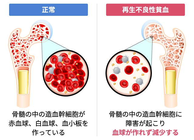 正常な骨髄と再生不良性貧血の骨髄内部の比較イラスト。再生不良性貧血では造血幹細胞に障害が起こり、赤血球・白血球・血小板が作られず骨髄内がスカスカになっている様子。
