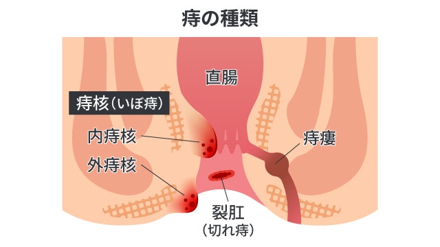 痔について説明する図です