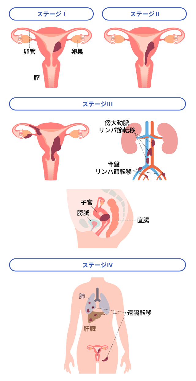 子宮体癌のステージについて教えてください。 ｜子宮体癌