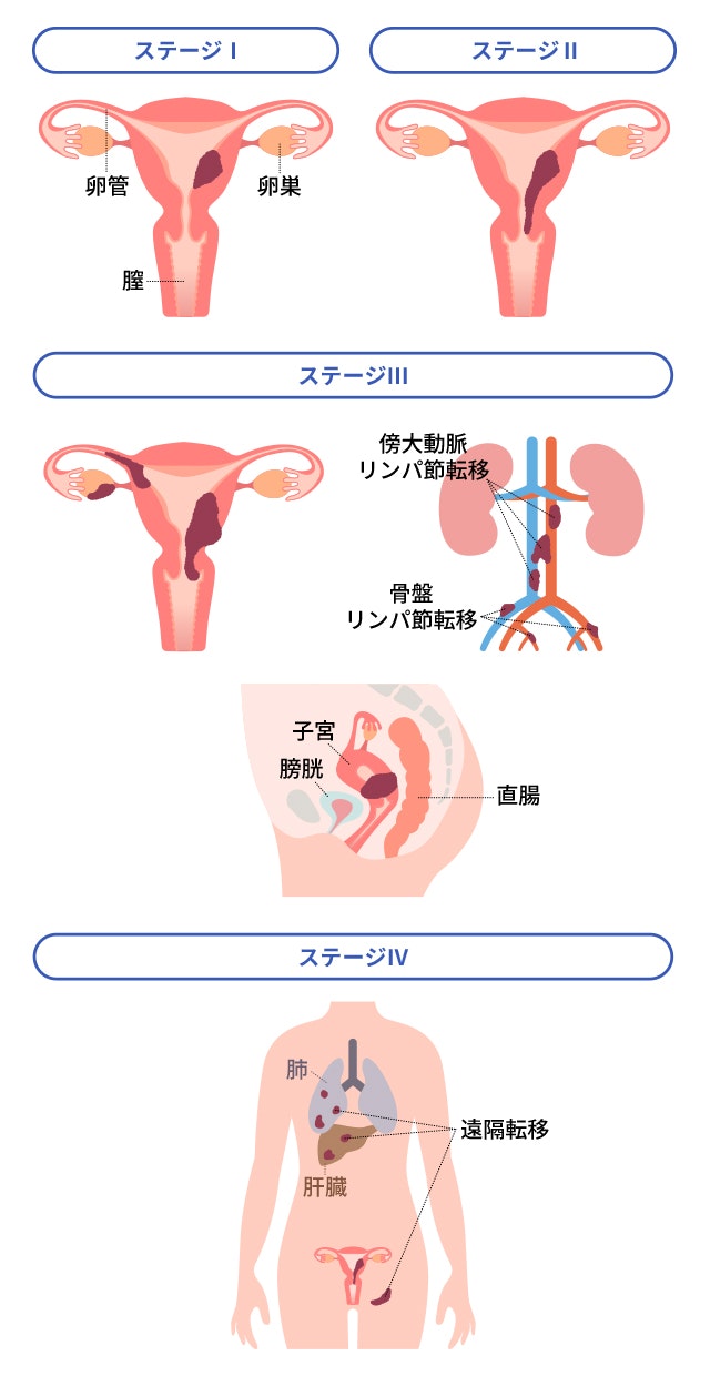 子宮体がんのステージ分類を説明する図です