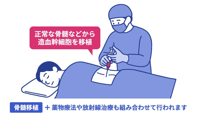 再生不良性貧血の治療である「骨髄移植（造血幹細胞移植）」のイメージイラスト。正常な骨髄から造血幹細胞を移植する処置の様子を描写。治療は移植単独ではなく、薬物療法や放射線治療と組み合わせて行われます。
