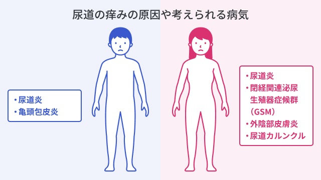 尿道の痒みを引き起こす原因は、主に尿道炎が考えられますが、下記のように亀頭包皮炎、閉経関連泌尿生殖器症候群（GSM）など、尿道の周囲の炎症による可能性も考えられます。