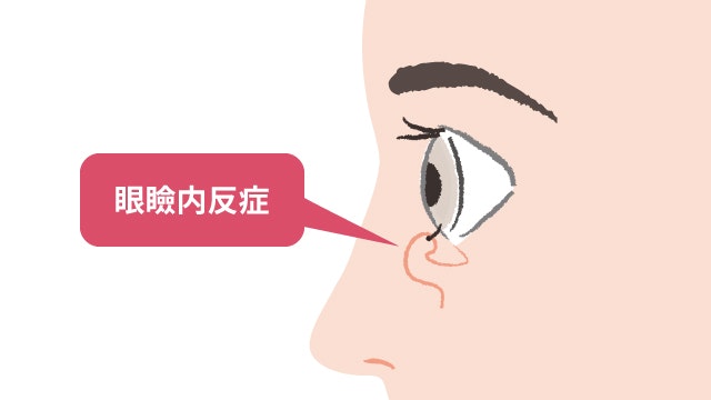 眼瞼内反症を説明する図です