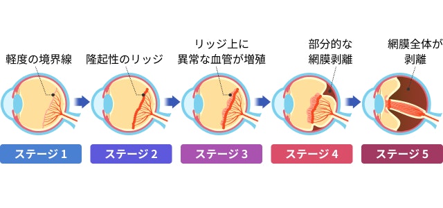 未熟児網膜症のステージを説明する図です