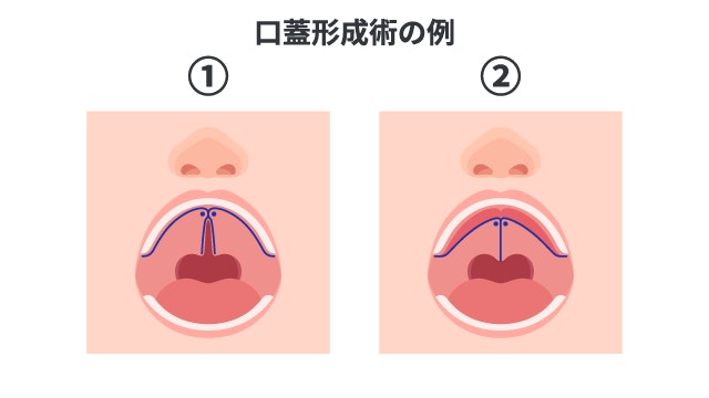 口蓋裂において、口蓋形成術による治療イメージ。口を開けたイラストに、①で上あごの裂け目に沿った切開線を、②で左右を中央で縫い合わせて裂け目を塞いだ状態を順番に示しています。