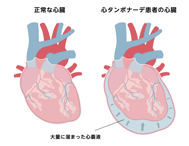 正常な心臓と、心タンポナーデ患者の心臓