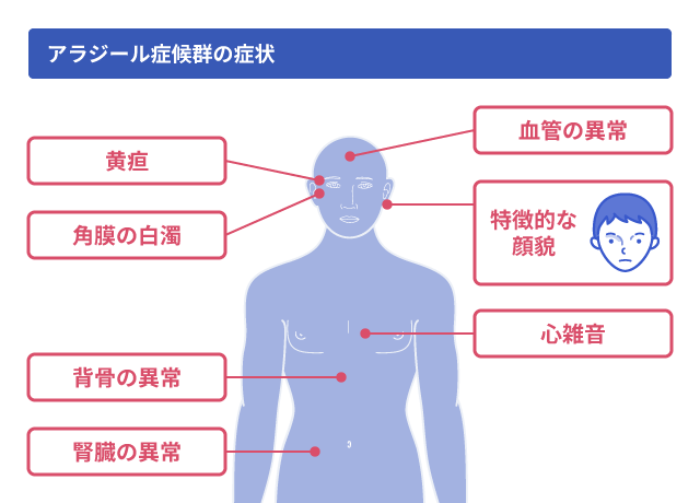 アラジール症候群の症状を説明する図です