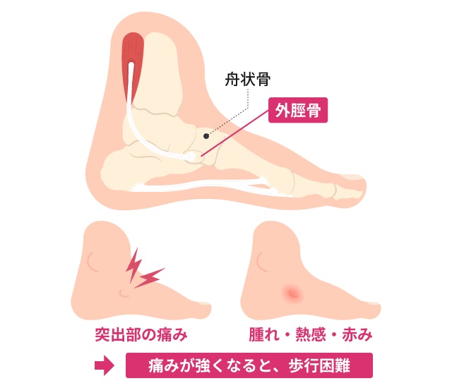 有痛性外脛骨の主な症状が足のどの部分に現れるかを示したイラスト。足の骨の突出部に生じる痛みや、腫れ、熱感、赤みといった状態、さらに痛みが強くなると歩行困難になることを視覚的に解説しています。
