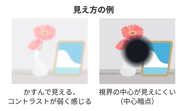 視神経炎の見え方について説明する図です