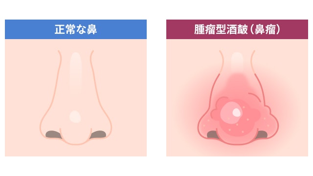 酒さは鼻に赤みや腫れを引き起こし、特に重症化するとコブのような腫瘤ができることがあります。