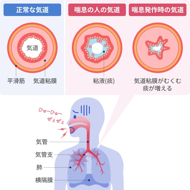 喘息発作を説明する図です