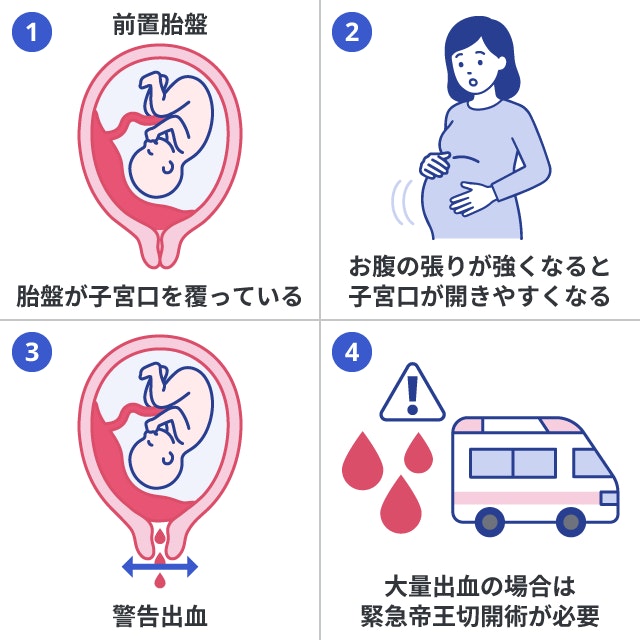 前置胎盤の症状である警告出血の仕組みと注意点を4つのイラストで解説しています。胎盤が子宮口を覆っているため、お腹の張りなどにより子宮口が開いて出血することや、大量出血時に緊急帝王切開が必要となることを描いています。